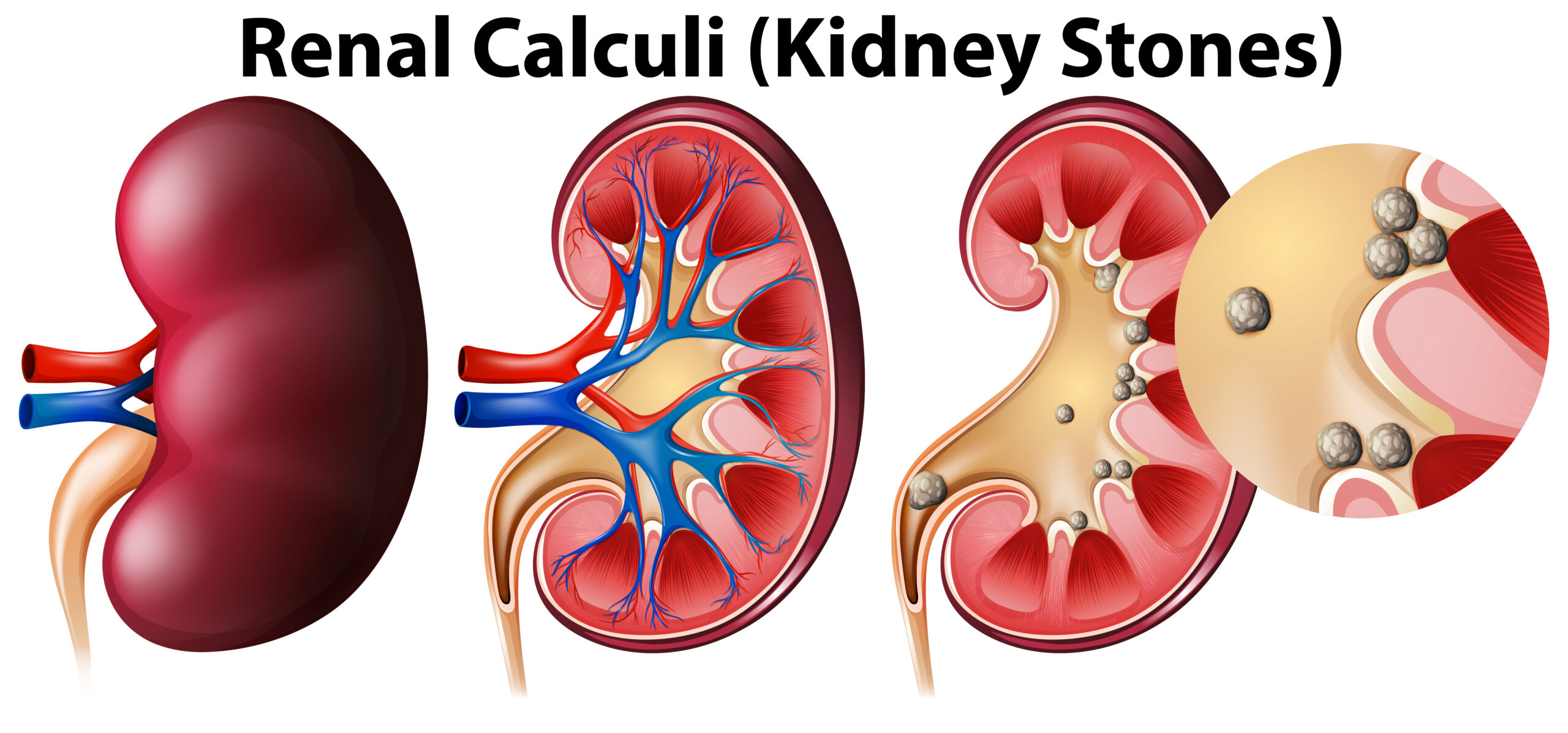 Expert Opinions on Kidney Stones: Understanding the Condition and Effective Management