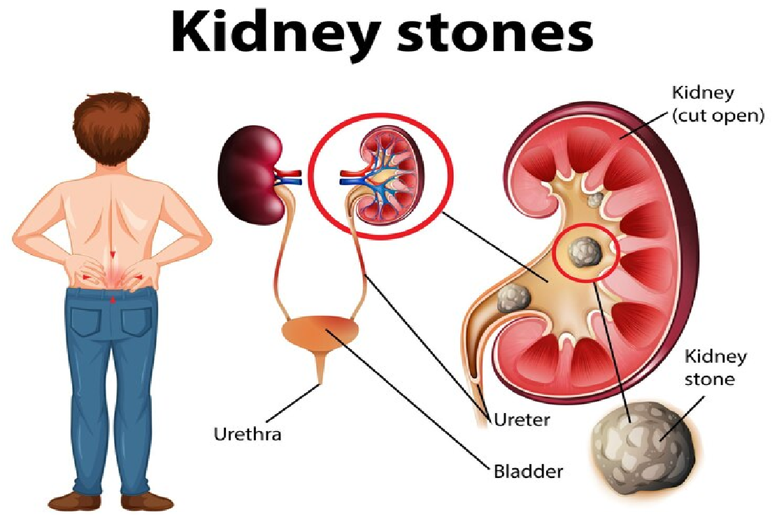 Kidney Stone Formation: Recent Advances in Understanding and Prevention