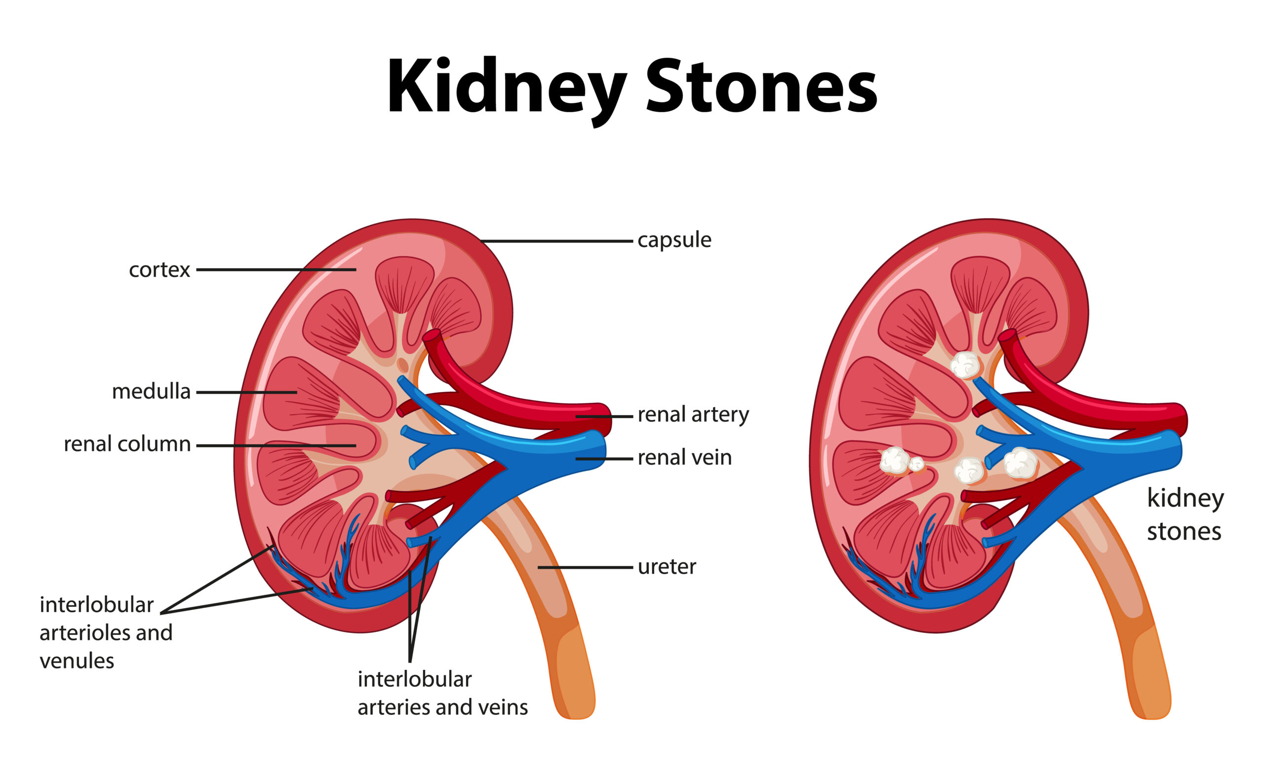 The Intricate Process: How Kidney Stones Form
